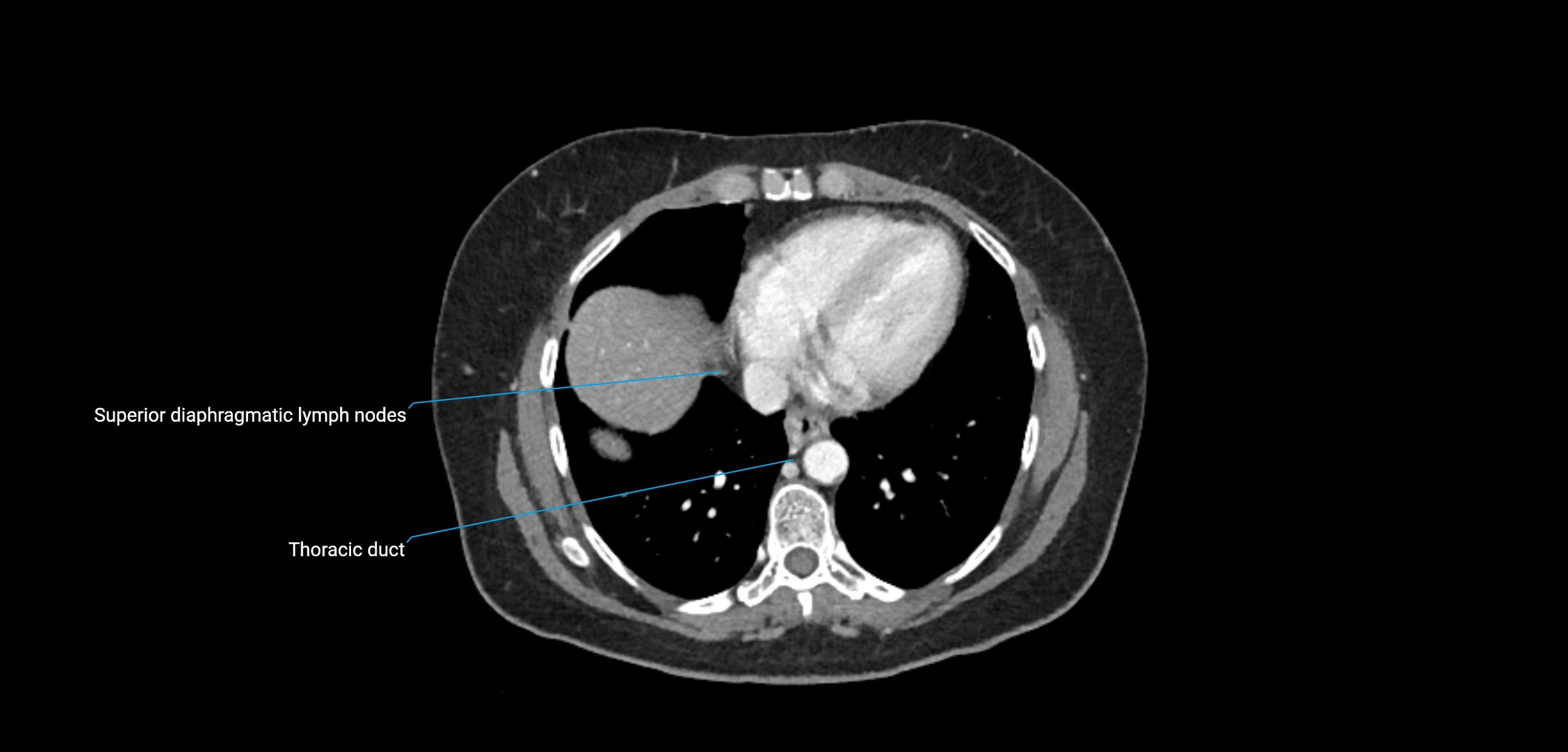 CT ct abdominal lymph nodes  axial cross sectional anatomy  enchanced radiology image -img-00002-00055.webp